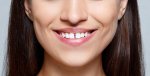 gap-in-teeth.jpg