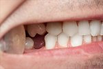 congenital-missing-teeth-2.jpg